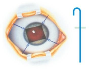 IRIS Retractor Sterilize