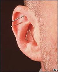 Ear ACUPUNCTURE Needle