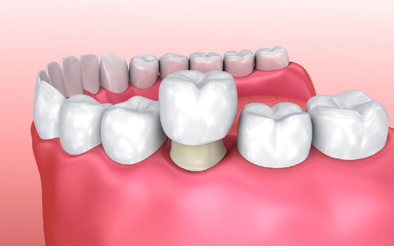 Dental Crown Fixing Services