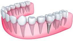  0-10gm dental implants, for Lab Use