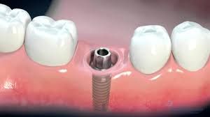 0-10gm Dental Implants, For Lab Use