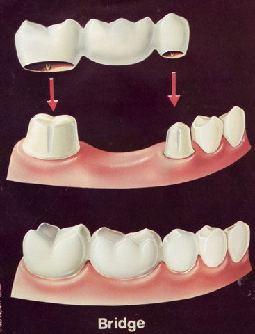 Dental Bridge Treatment Services