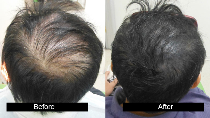 hair transplant cosmetic surgery by AG Clinics - Hair Transplant in  Jalandhar from Jalandhar Punjab | ID - 5290564