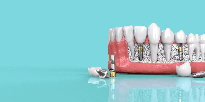 Dental Implant Services