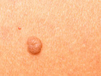 Skin Tag Removal Treatment