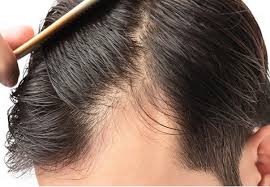 Hair Loss Treatment Service