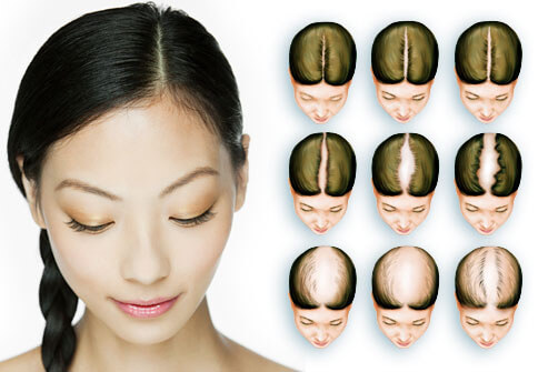 Female Pattern Baldness (Female Hair Loss)