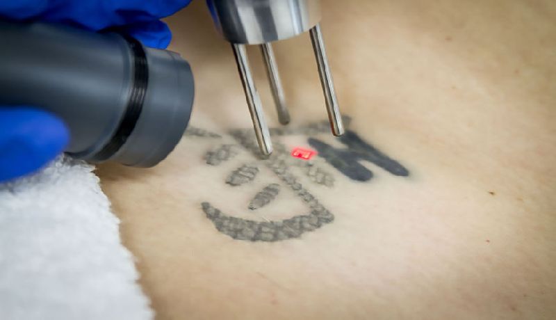 Laser Tattoo Removal Services