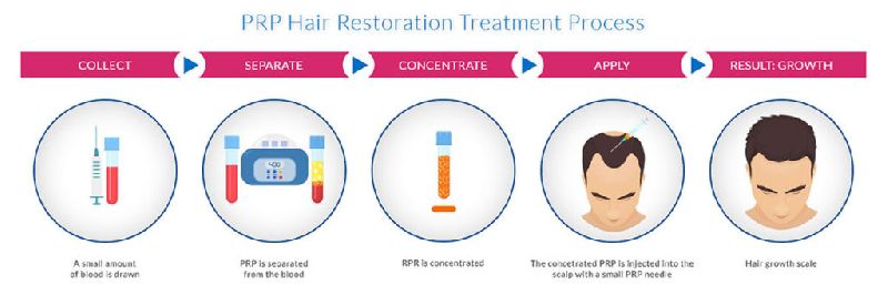 Platelet Rich Plasma Treatment for Hair Loss