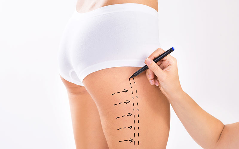 Mini Tummy Tuck Surgery Service at best price in Ahmedabad
