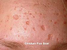 chickenpox vaccine after effects