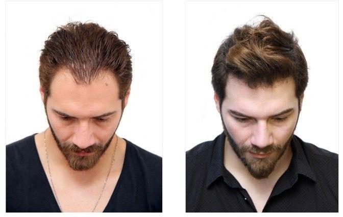 growuphairtransplant
