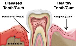Complete Gum Treatment