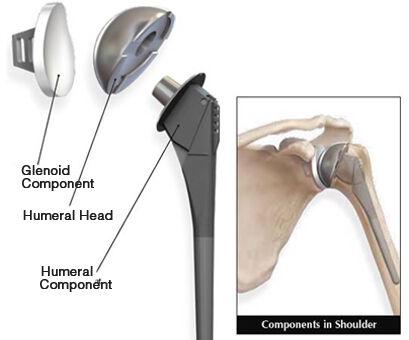 Total Shoulder Replacement Services