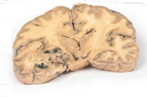 Astrocytoma 3D Anatomical Model