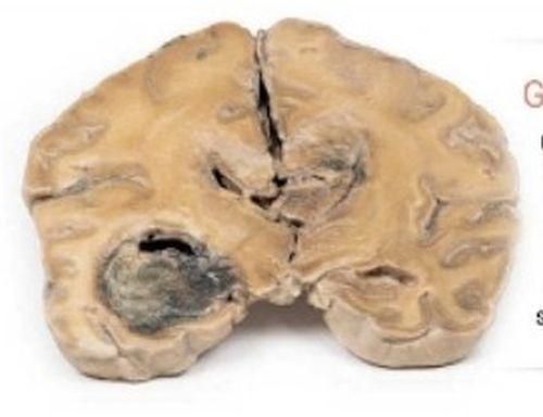 Glioblastoma Multiforme 3D Anatomical Model