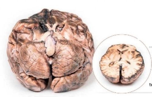 Rupturd Berry Aneurysm 3D Anatomical Model