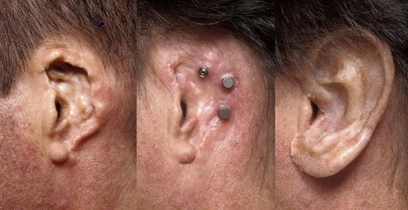 Silicone Ear Prosthesis