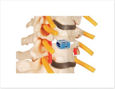 Cervical Anterior Fusion Cage