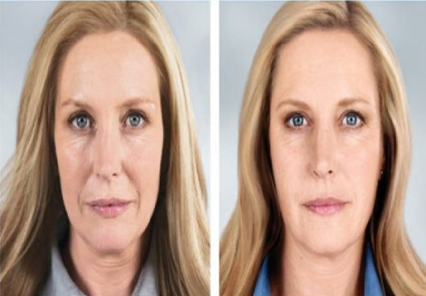 Facelift procedure service