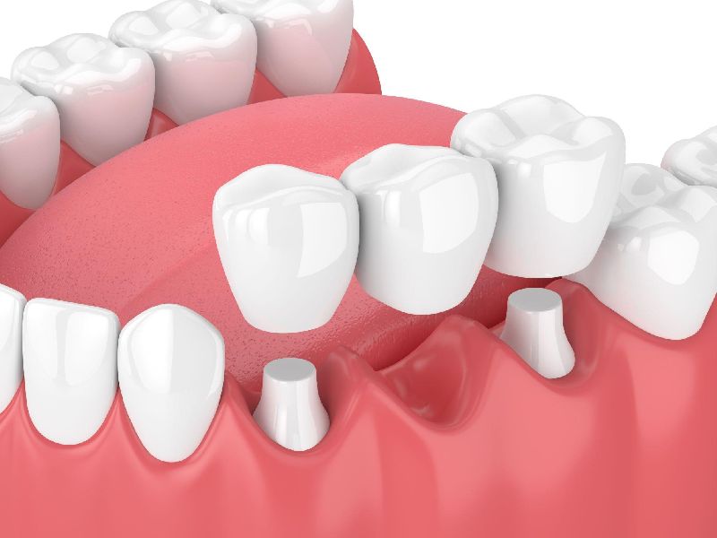 Dental bridge, Packaging Type : Box