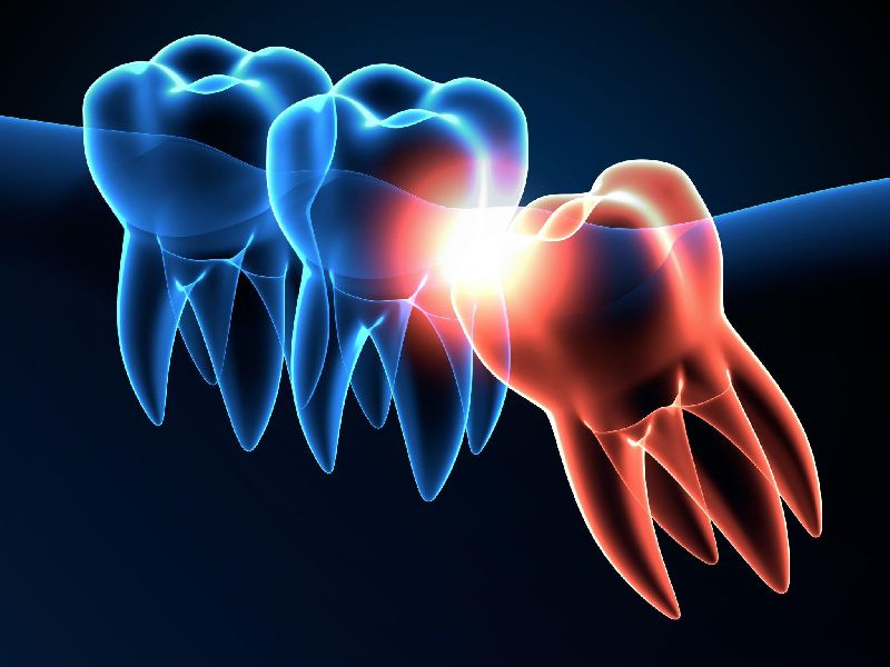Wisdom tooth extractions
