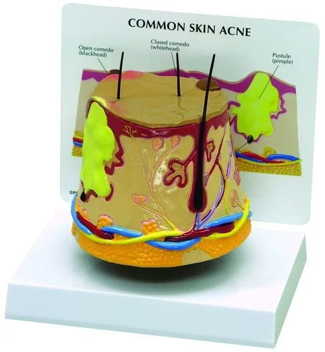 PP Acne Skin Model for Medical College