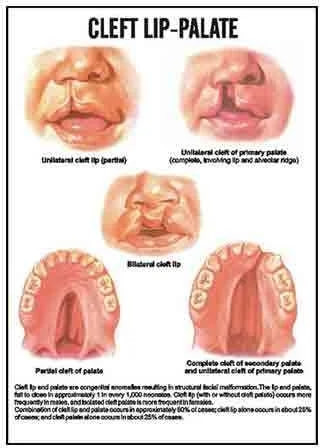 Paper Cleft Lip-Palate Chart for Biological Labs, Hospital, School