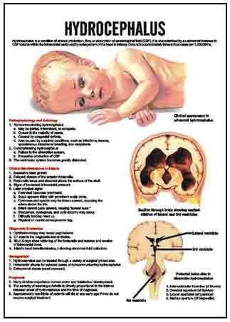 Paper Hydrocephalus Chart for Biological Labs, Hospital, School