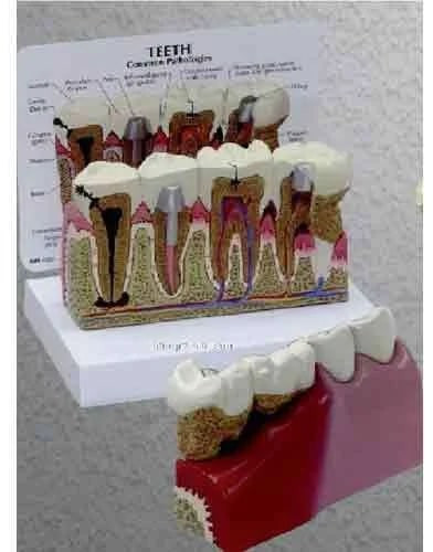PVC Teeth Model With Plate for Medical College