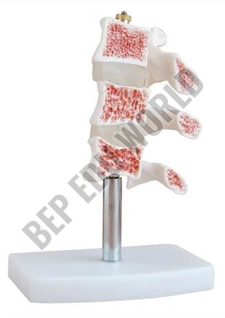 Osteoporosis Bone Joint Model