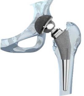 Hip Prosthesis