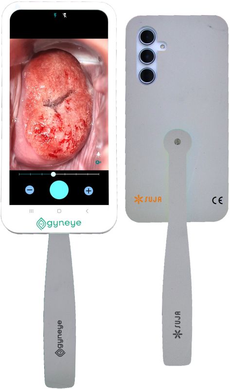 Digital Colposcope