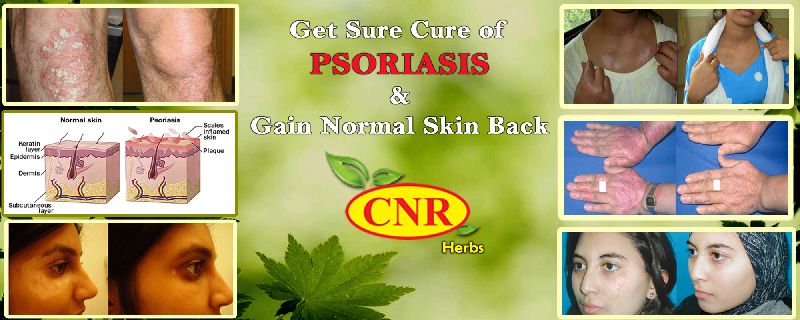 CNR HERBS Treatment of Psoriasis