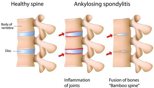 Yoga Treatment for Ankylosing Spondylitis