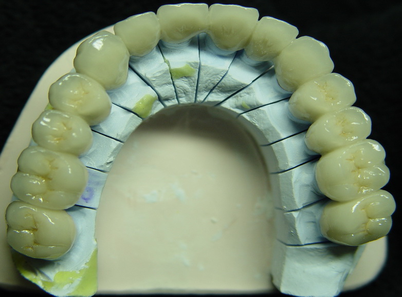 Dental Ceramic Laminations