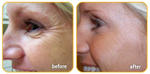 Dysport Non-surgical Wrinkle Remove Botox