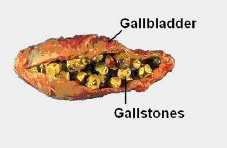 gall bladder stone removal ayurvedic medicine