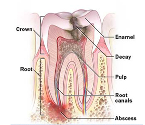 Root Canal File