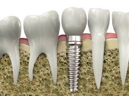 Titanium Dental Implant