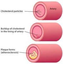 high cholesterol treatment