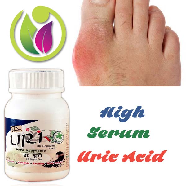 High Serum Uric Acid