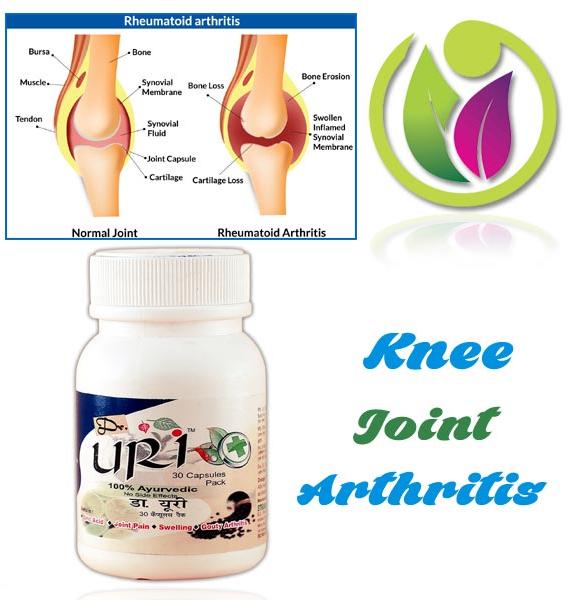 Knee Joint Arthritis