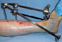 External Fixator