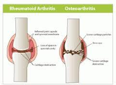 arthritis treatment services