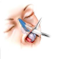 3-d Nasal Implant