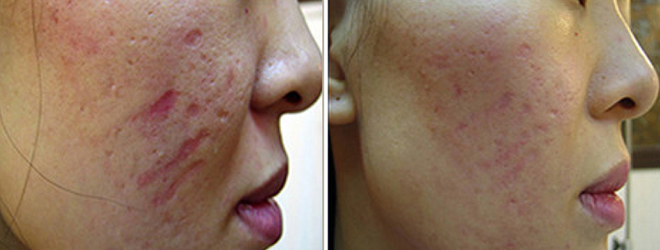 PITTED SCARS TREATMENT