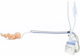Rt329 Oxygen Therapy Infant Kit 10/ca