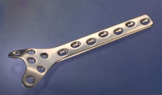Condylar Buttress Plate