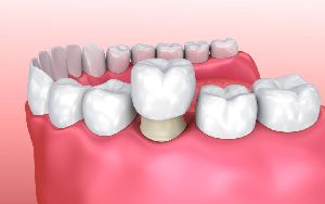 Dental Crown Fixing Services